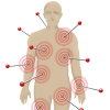 Fibromialgia