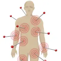 Fibromialgia