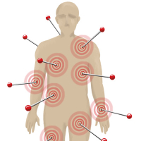 Fibromialgia