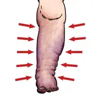 Zakrzepica