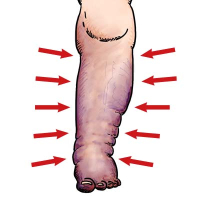 Zakrzepica